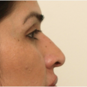 45-54 year old woman treated with Rhinoplasty before 3449086