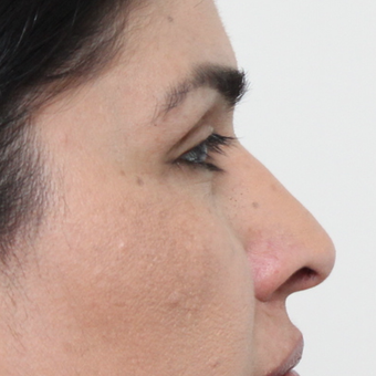 45-54 year old woman treated with Rhinoplasty after 3449086