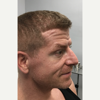 35-44 year old man treated with Botox before 3782163