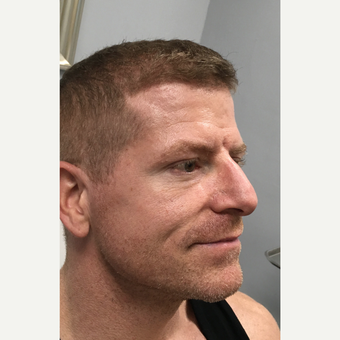 35-44 year old man treated with Botox after 3782163
