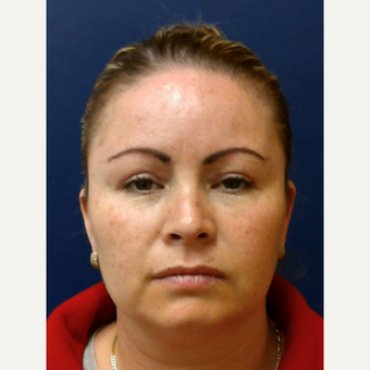 35-44 year old woman treated with Eyelid Surgery after 3693829