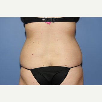 20 year-old woman treated with Liposuction of the Lovehandles after 1550843