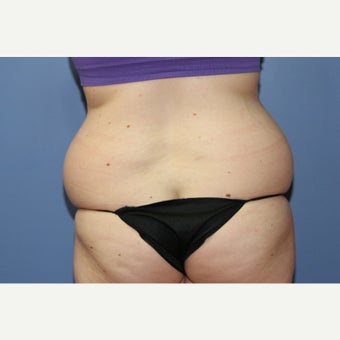 20 year-old woman treated with Liposuction of the Lovehandles before 1550843