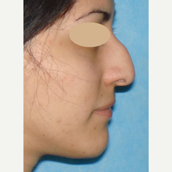 Rhinoplasty, open before 3618778