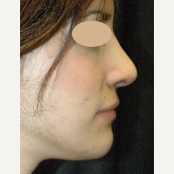 Rhinoplasty, open after 3618778