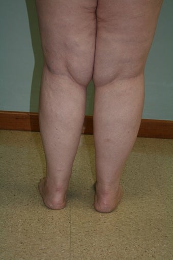 43 year old with large lax thighs 1484137
