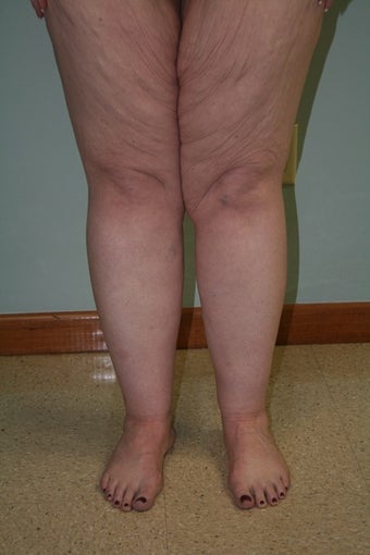 43 year old with large lax thighs before 1484137