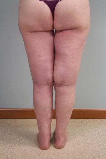 43 year old with large lax thighs 1484137