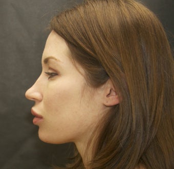27 year old female with upper and lower lip implants after 1106822