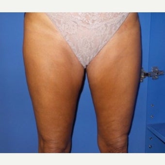 35-44 year old woman treated with Cellulaze after 2325069