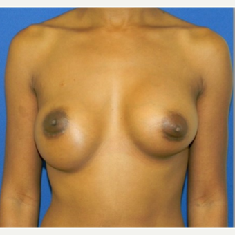 25-34 year old woman treated with breast implant Revision before 3408431