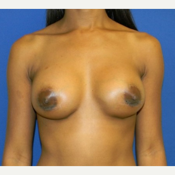 25-34 year old woman treated with breast implant Revision after 3408431