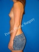 Breast Augmentation, Silicone gel Implants 1486264