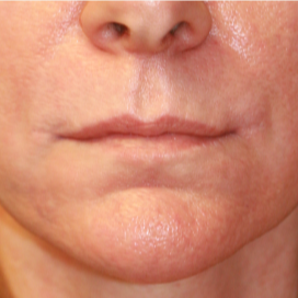 45-54 year old woman treated with Lip Lift after 3560861