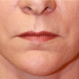 45-54 year old woman treated with Lip Lift before 3560861