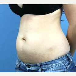25-34 year old woman treated with Liposuction before 3140313