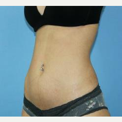 25-34 year old woman treated with Liposuction after 3140313