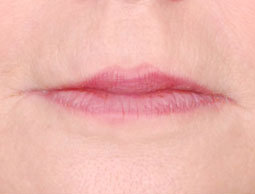 Restylane Lip Injection before 222099