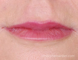 Restylane Lip Injection after 222099