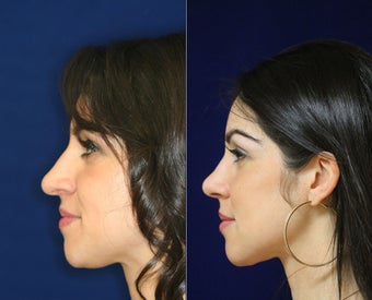 Nose Surgery before 1430614