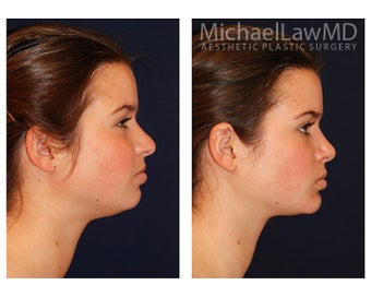 Chin Liposuction before 1271805