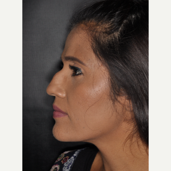 25-34 year old woman treated with Nose Surgery 10 days post-op before 3452325