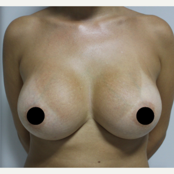 25-34 year old woman treated with Breast Augmentation after 3184656