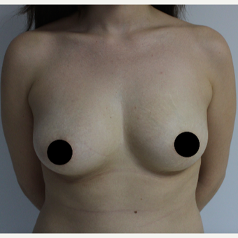 25-34 year old woman treated with Breast Augmentation before 3184656