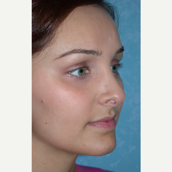 Rhinoplasty results on this 21 year old female after 3732601