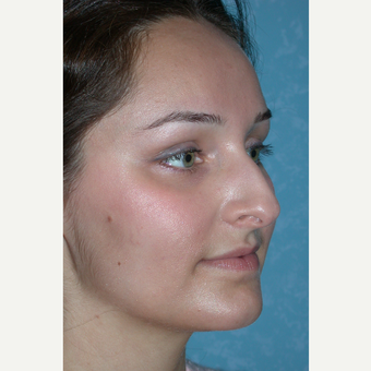 Rhinoplasty results on this 21 year old female before 3732601