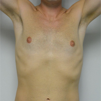 25-34 year old man treated with Male Breast Reduction before 3683752