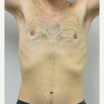 25-34 year old man treated with Male Breast Reduction after 3683752