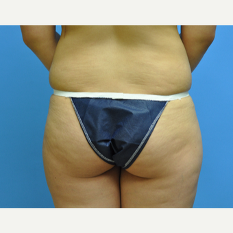 30 year old woman treated with Brazilian Butt Lift before 2956391