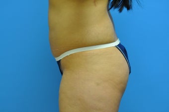 30 year old woman treated with Brazilian Butt Lift 2956391