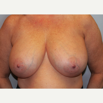 55-64 year old woman treated with Breast Reduction before 3803194