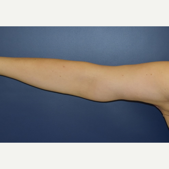 25-34 year old woman treated with Arm Lift after 3489799