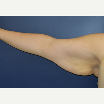 25-34 year old woman treated with Arm Lift before 3489799