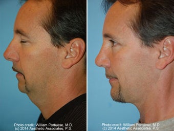 Neck Liposuction before 1389493