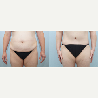 35-44 year old woman treated with Body Lift before 3099805