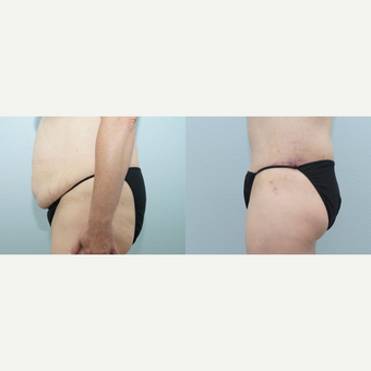 35-44 year old woman treated with Body Lift after 3099805