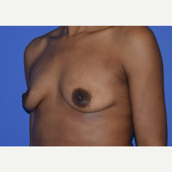 Breast Augmentation with Ideal Saline Breast Implants 350 cc before 3080174