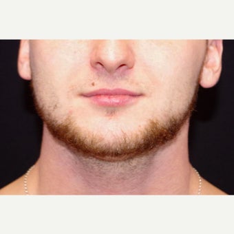 18-24 year old man treated with CoolSculpting to the Chin; 2 months post-op after 2670950