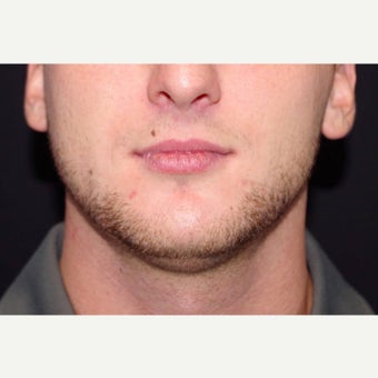 18-24 year old man treated with CoolSculpting to the Chin; 2 months post-op before 2670950