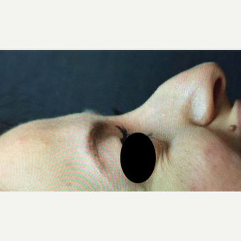 25-34 year old woman treated with Rhinoplasty before 3211283