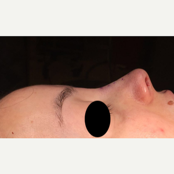 25-34 year old woman treated with Rhinoplasty after 3211283