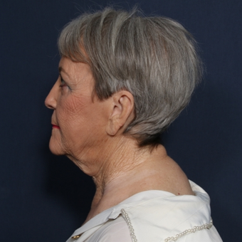 65-74 year old woman treated with Neck Lift (view 2 of 2) before 3180014