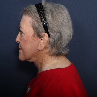 65-74 year old woman treated with Neck Lift (view 2 of 2) after 3180014