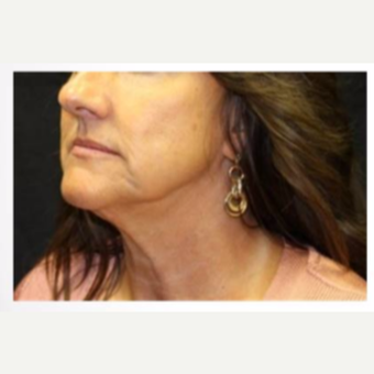 45-54 year old woman treated with Ultherapy before 3424054