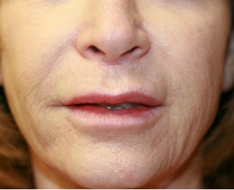 Four weeks after lip lift before 807761