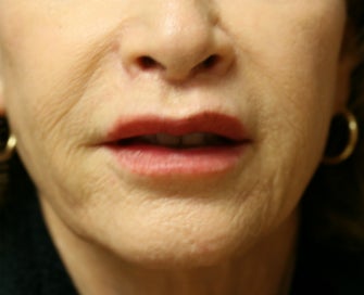 Four weeks after lip lift after 807761